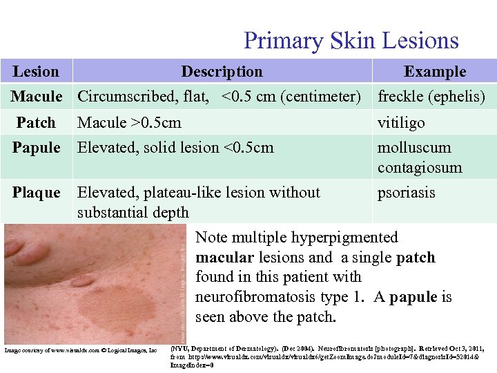 Primary Skin Lesions Lesion Description Example Macule Circumscribed, flat, <0. 5 cm (centimeter) freckle