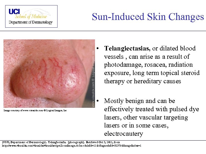 Sun-Induced Skin Changes • Telangiectasias, or dilated blood vessels , can arise as a