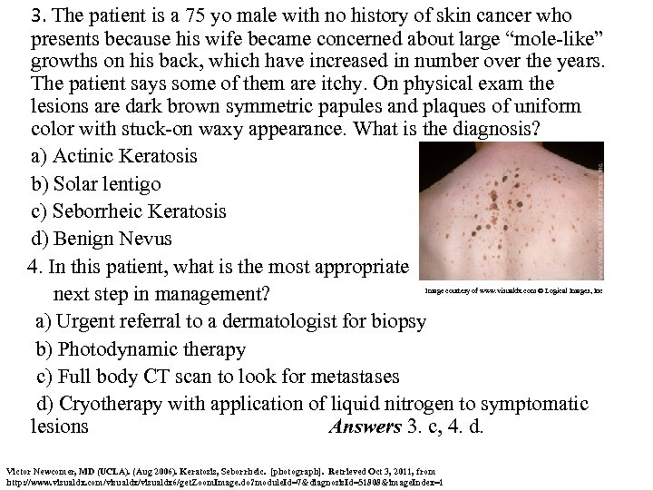 3. The patient is a 75 yo male with no history of skin cancer