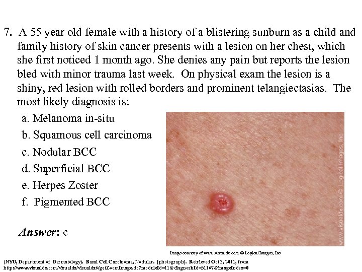 7. A 55 year old female with a history of a blistering sunburn as