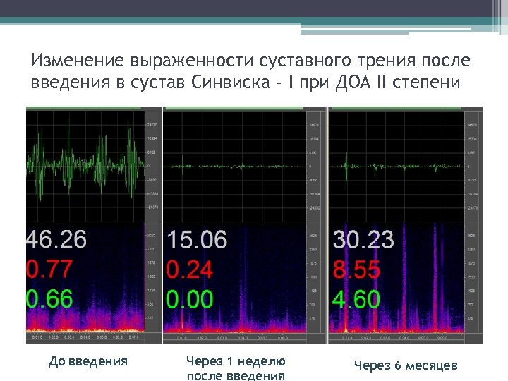 Изменение выраженности суставного трения после введения в сустав Синвиска - I при ДОА II