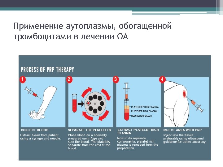 Применение аутоплазмы, обогащенной тромбоцитами в лечении ОА 