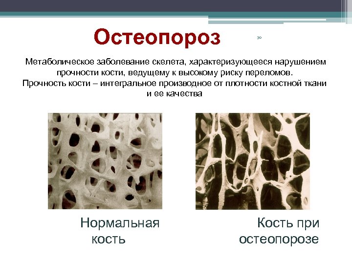 Остеопороз 30 Метаболическое заболевание скелета, характеризующееся нарушением прочности кости, ведущему к высокому риску переломов.