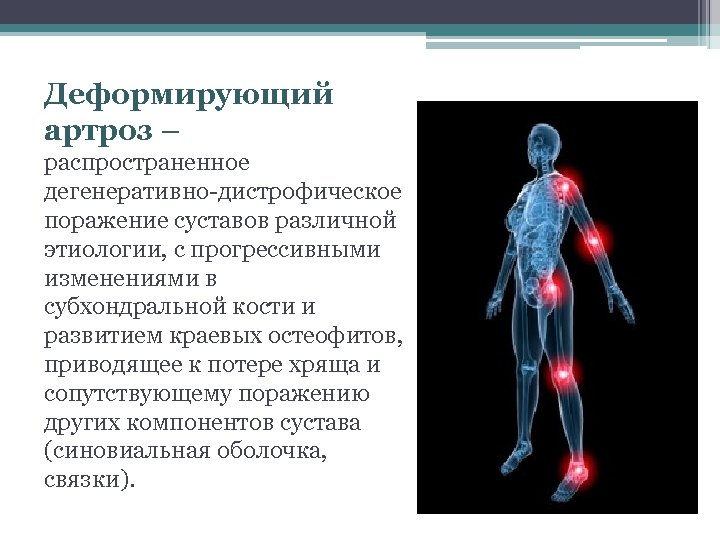 Деформирующий артроз презентация