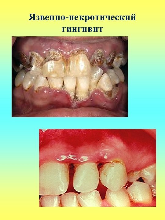 Язвенно-некротический гингивит 