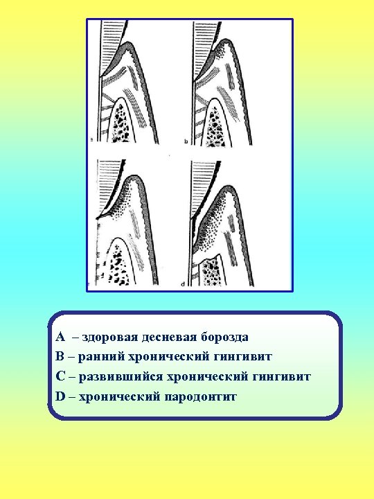 А – здоровая десневая борозда B – ранний хронический гингивит С – развившийся хронический