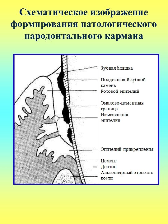 Схематическое изображение формирования патологического пародонтального кармана 