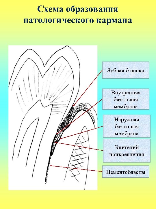 Схема образования патологического кармана Зубная бляшка Внутренняя базальная мембрана Наружная базальная мембрана Эпителий прикрепления