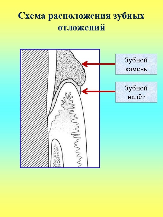 Схема расположения зубных отложений Зубной камень Зубной налёт 