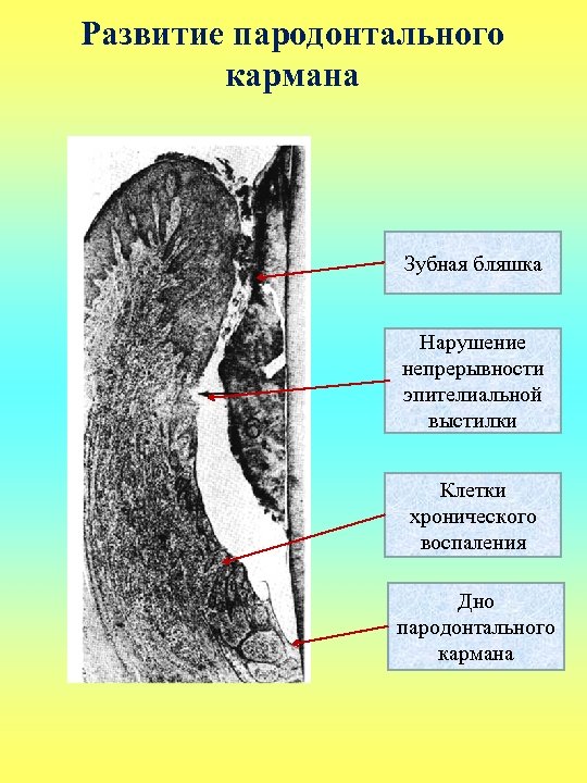 Развитие пародонтального кармана Зубная бляшка Нарушение непрерывности эпителиальной выстилки Клетки хронического воспаления Дно пародонтального