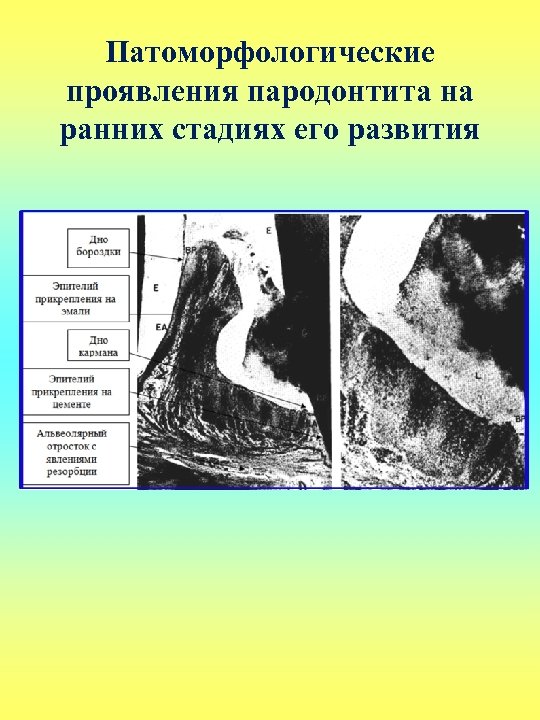 Патоморфологические проявления пародонтита на ранних стадиях его развития 