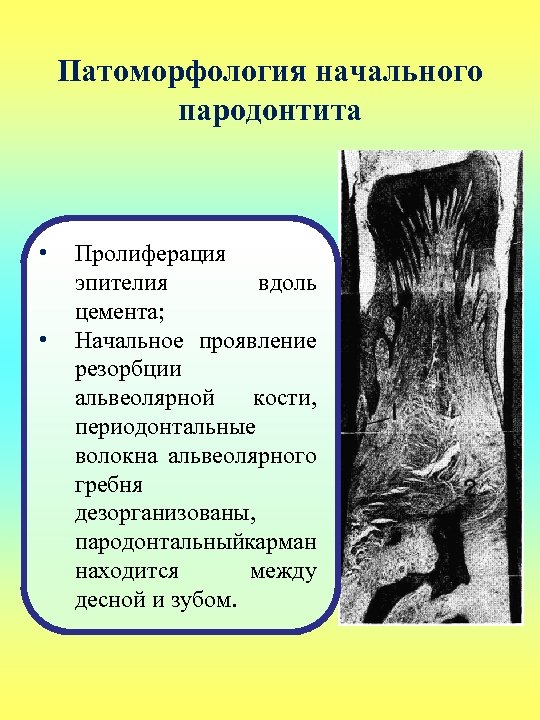 Патоморфология начального пародонтита • • Пролиферация эпителия вдоль цемента; Начальное проявление резорбции альвеолярной кости,