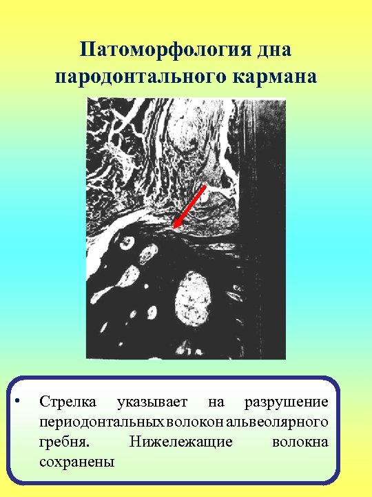 Патоморфология дна пародонтального кармана • Стрелка указывает на разрушение периодонтальных волокон альвеолярного гребня. Нижележащие