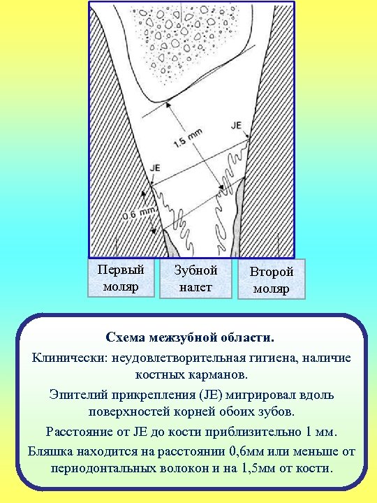 Первый моляр Зубной налет Второй моляр Схема межзубной области. Клинически: неудовлетворительная гигиена, наличие костных