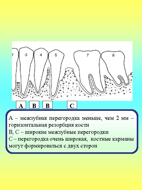 А В В С А – межзубная перегородка меньше, чем 2 мм – горизонтальная