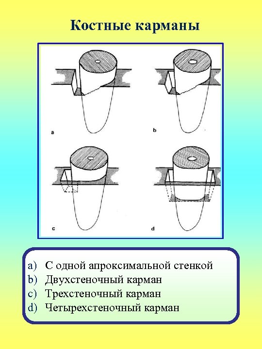 Костные карманы a) b) c) d) С одной апроксимальной стенкой Двухстеночный карман Трехстеночный карман