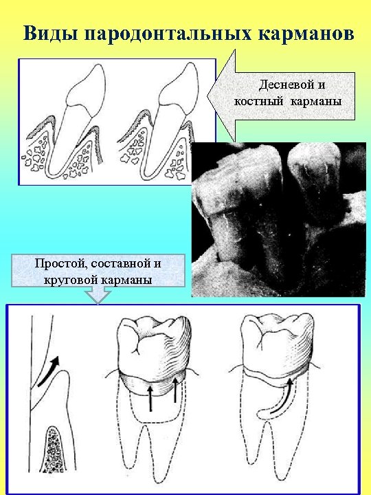 Виды пародонтальных карманов Десневой и костный карманы Простой, составной и круговой карманы 