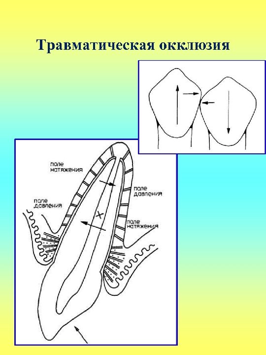 Травматическая окклюзия 