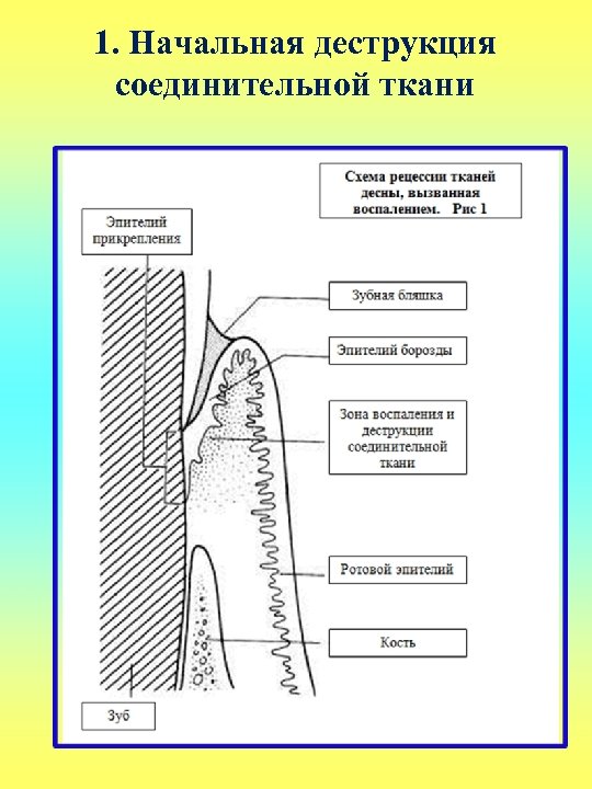 1. Начальная деструкция соединительной ткани 