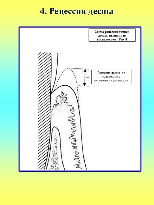 4. Рецессия десны 