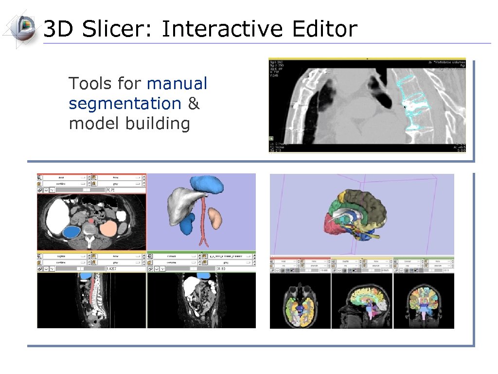 3 D Slicer: Interactive Editor Tools for manual segmentation & model building 
