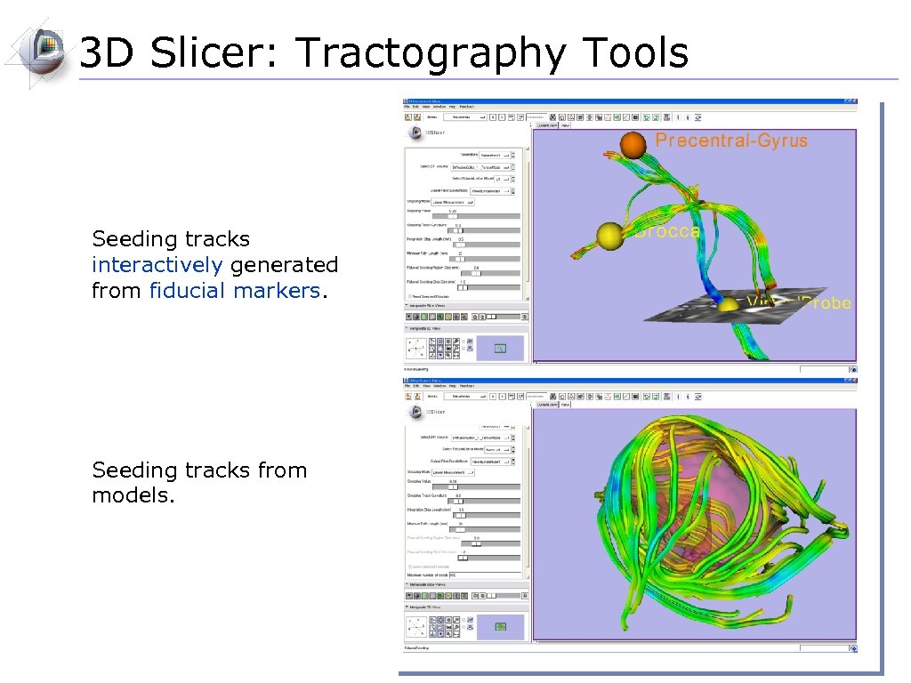 3 D Slicer: Tractography Tools Seeding tracks interactively generated from fiducial markers. Seeding tracks