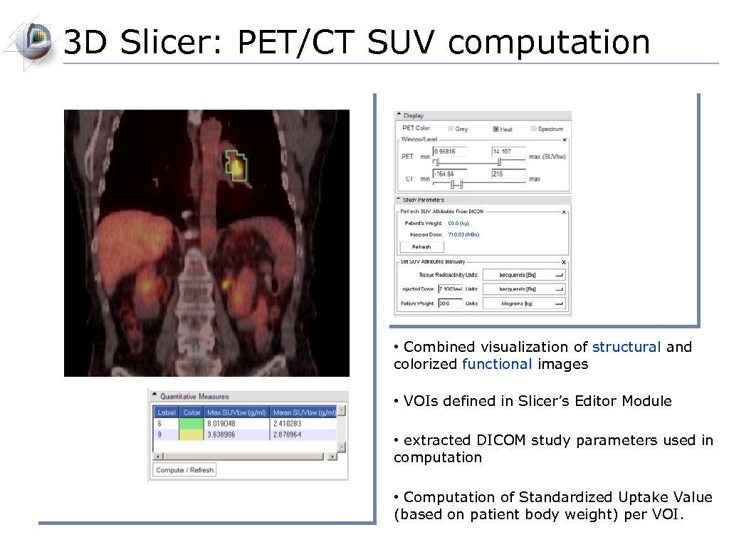 3 D Slicer: PET/CT SUV computation • Combined visualization of structural and colorized functional