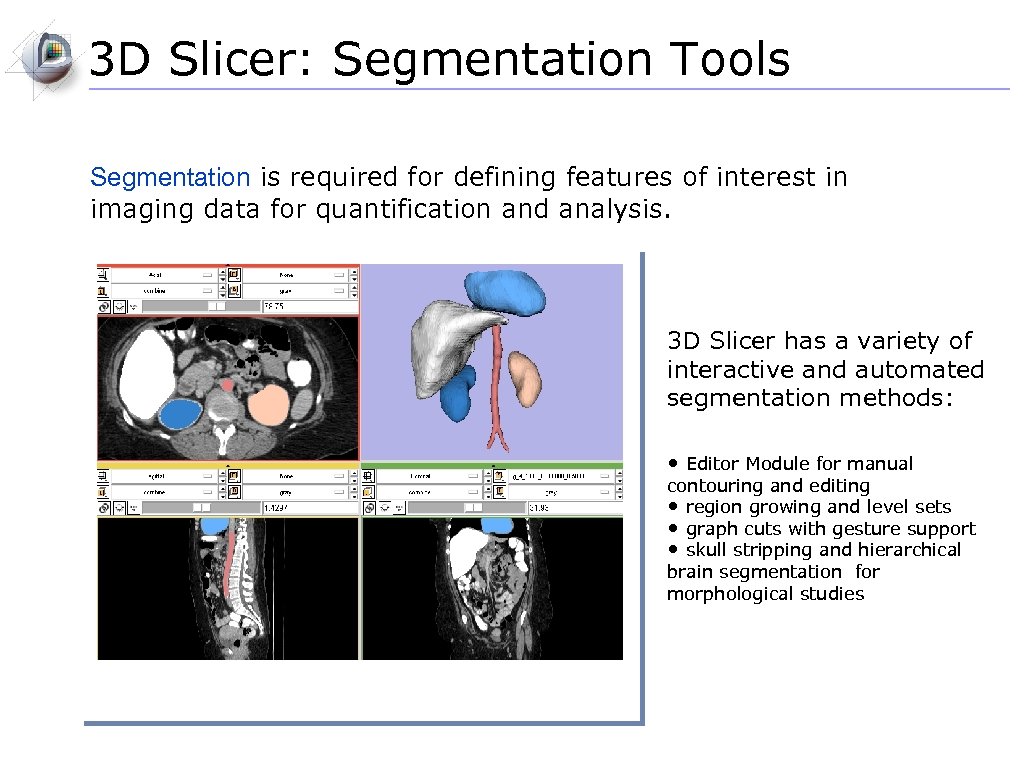 3 D Slicer: Segmentation Tools Segmentation is required for defining features of interest in