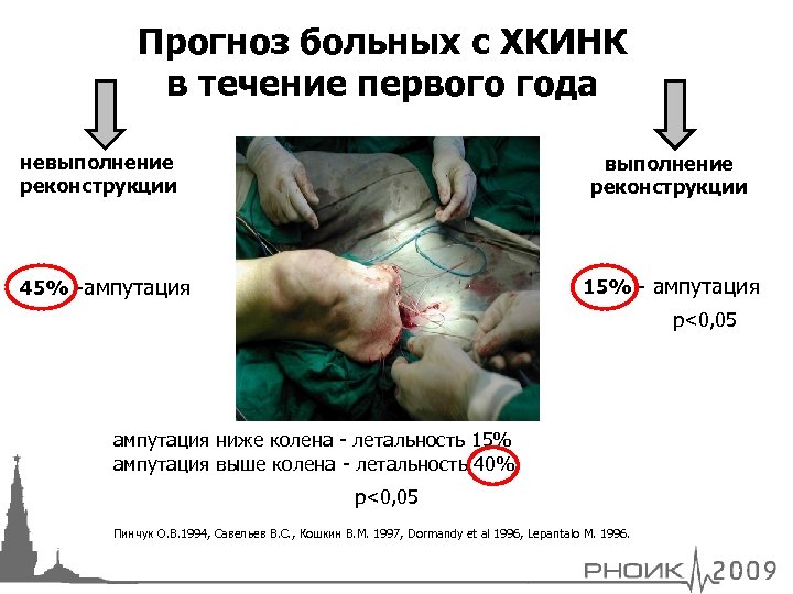 Прогноз больных с ХКИНК в течение первого года невыполнение реконструкции 15% - ампутация 45%