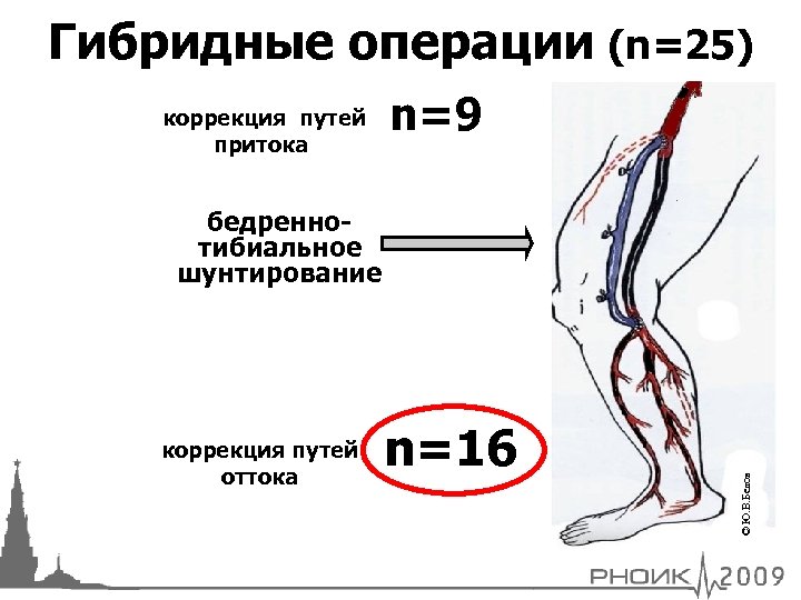 Гибридные операции (n=25) коррекция путей притока n=9 коррекция путей оттока n=16 © Ю. В.