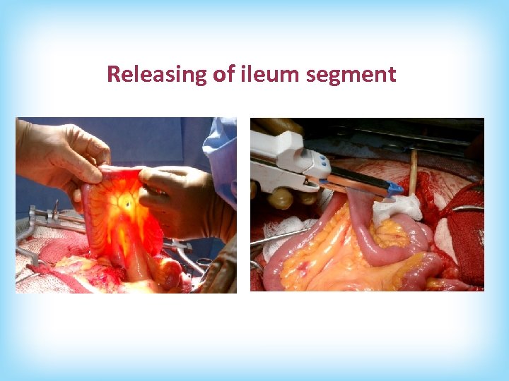 Releasing of ileum segment 