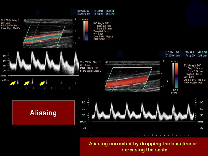 Aliasing corrected by dropping the baseline or increasing the scale 