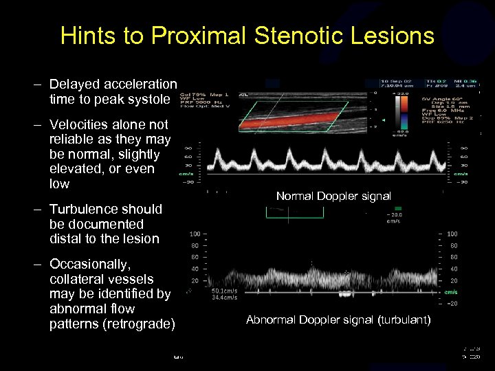 Hints to Proximal Stenotic Lesions – Delayed acceleration time to peak systole – Velocities
