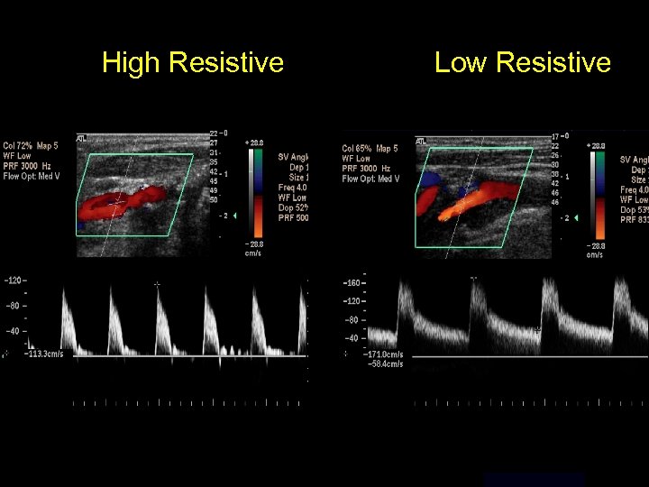High Resistive Low Resistive 