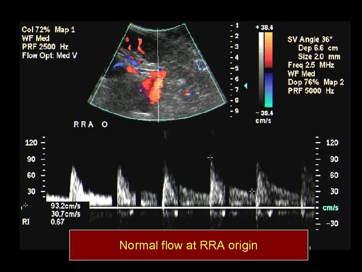 Normal flow at RRA origin 
