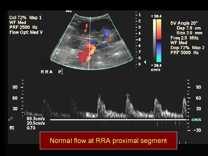 Normal flow at RRA proximal segment 