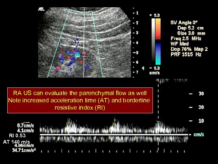 RA US can evaluate the parenchymal flow as well Note increased acceleration time (AT)