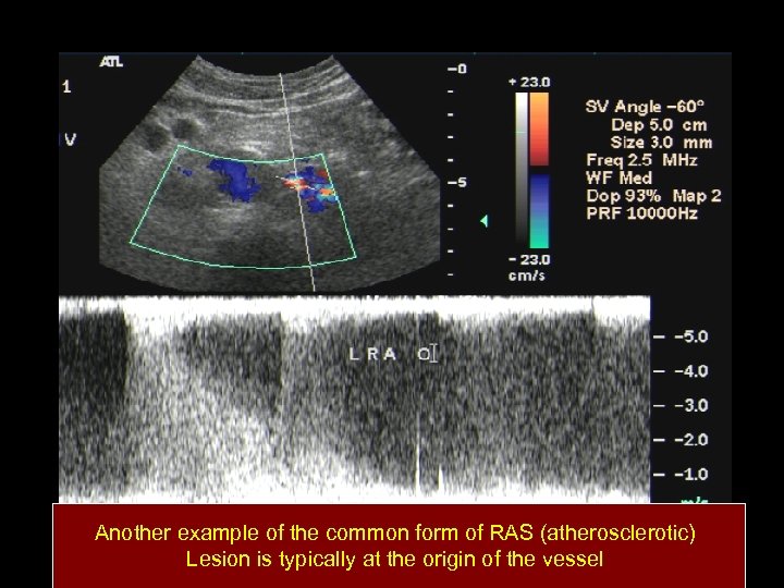 Another example of the common form of RAS (atherosclerotic) Lesion is typically at the