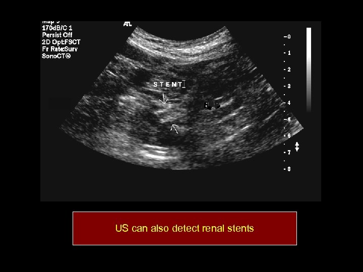 US can also detect renal stents 
