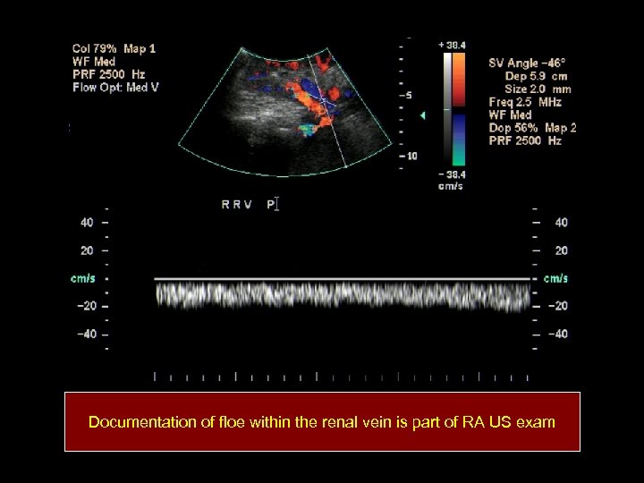 Documentation of floe within the renal vein is part of RA US exam 