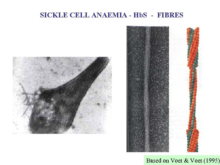 SICKLE CELL ANAEMIA - Hb. S - FIBRES Based on Voet & Voet (1995)