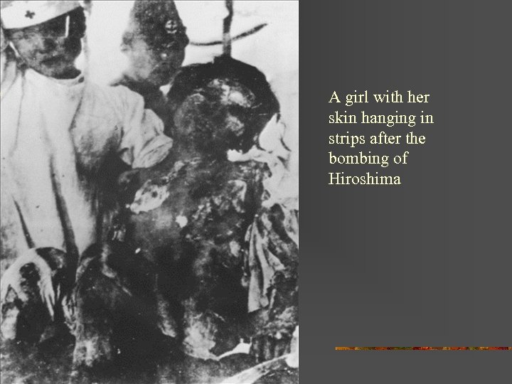 A girl with her skin hanging in strips after the bombing of Hiroshima 