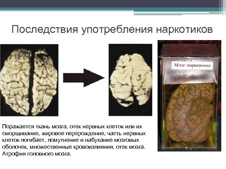 Последствия употребления наркотиков Поражается ткань мозга, отек нервных клеток или их сморщивание, жировое перерождение,