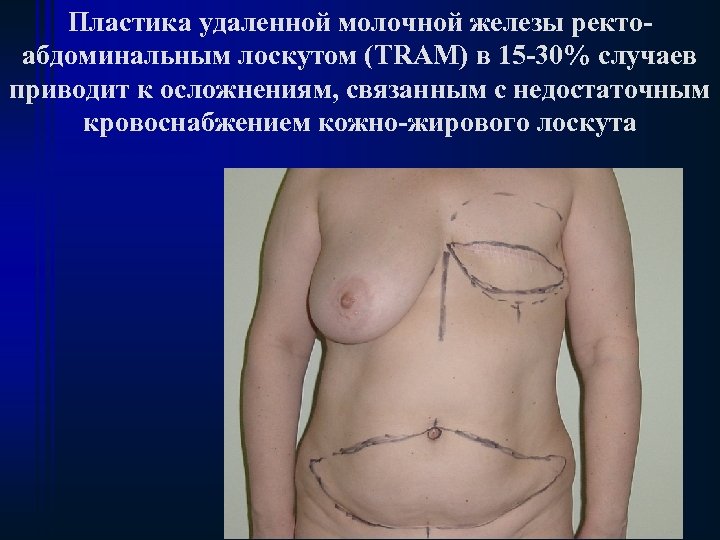Пластика удаленной молочной железы ректоабдоминальным лоскутом (TRAM) в 15 -30% случаев приводит к осложнениям,