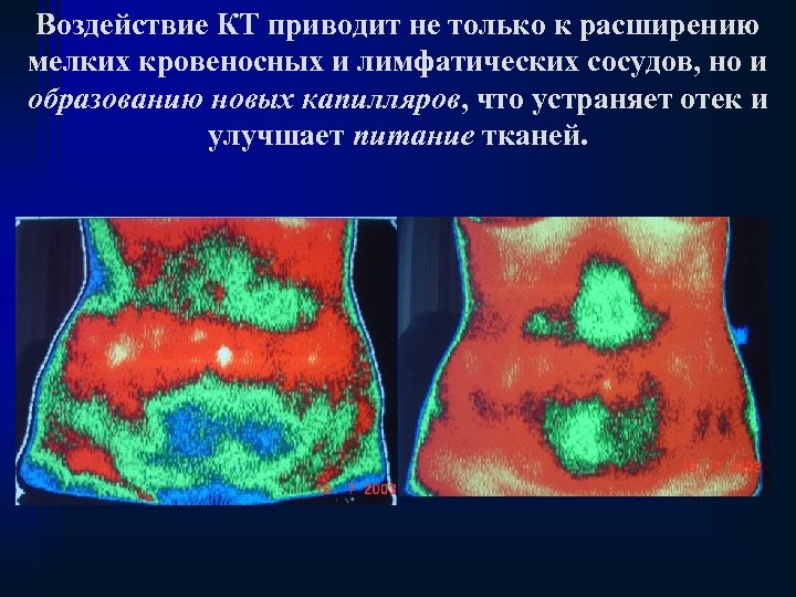 Воздействие КТ приводит не только к расширению мелких кровеносных и лимфатических сосудов, но и
