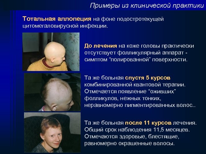 Примеры из клинической практики Тотальная аллопеция на фоне подостротекущей цитомегаловирусной инфекции. До лечения на