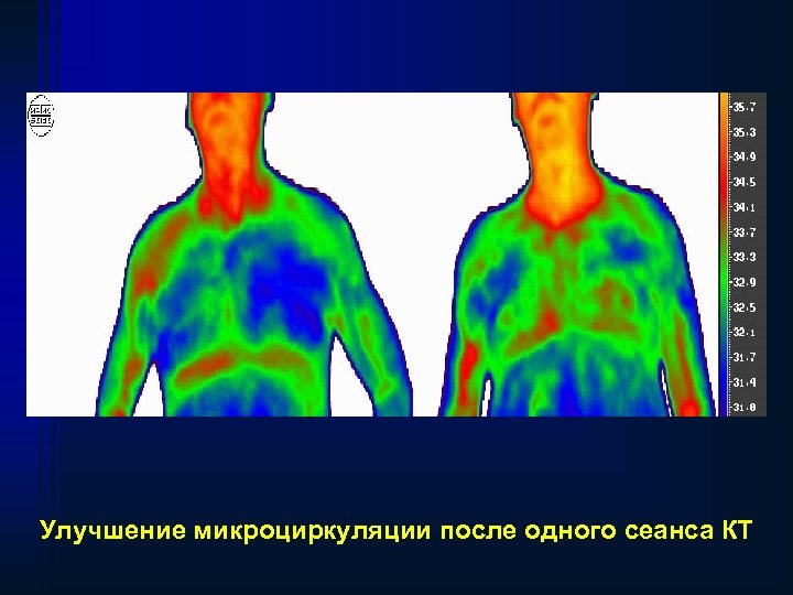 Улучшение микроциркуляции после одного сеанса КТ 
