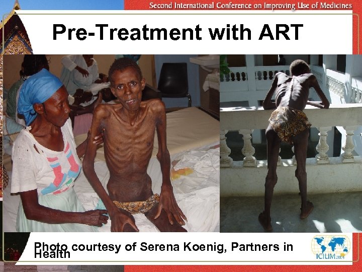 Pre-Treatment with ART Photo courtesy of Serena Koenig, Partners in Health 