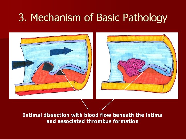3. Mechanism of Basic Pathology Intimal dissection with blood flow beneath the intima and