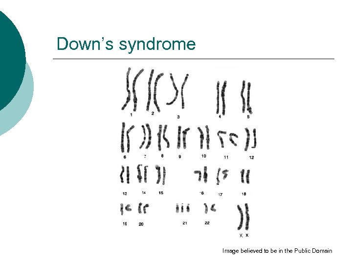 Down’s syndrome Image believed to be in the Public Domain 